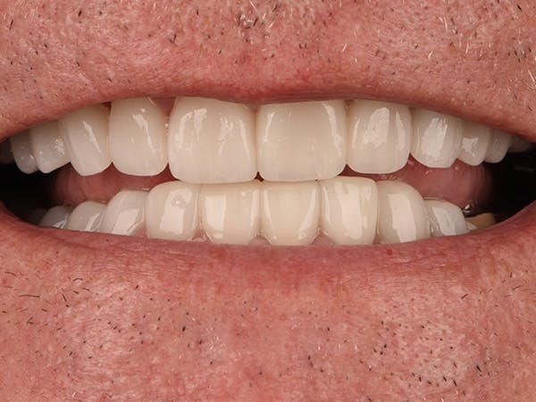 Full Mouth Restoration Before & After Gallery - Patient 167967 - Image 2