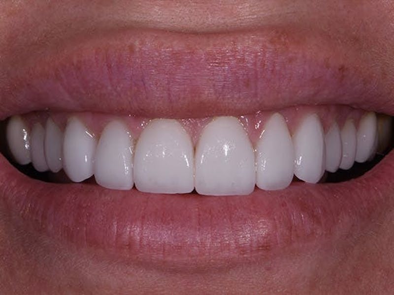 Full Mouth Restoration Before & After Gallery - Patient 209913 - Image 1