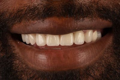 Full Mouth Restoration Before & After Gallery - Patient 348668 - Image 2