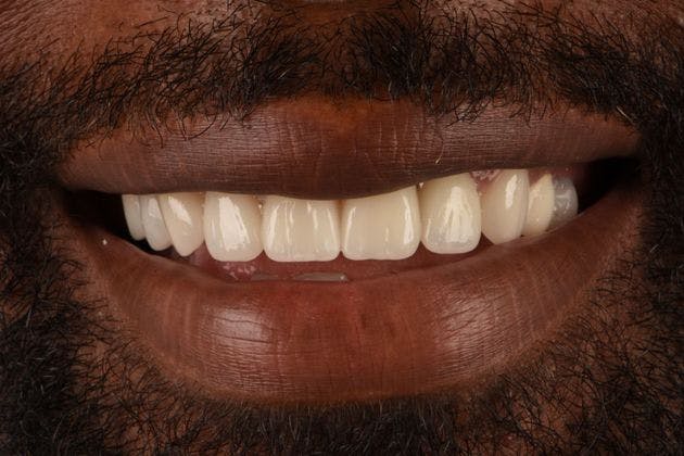 Full Mouth Restoration Before & After Gallery - Patient 348668 - Image 2