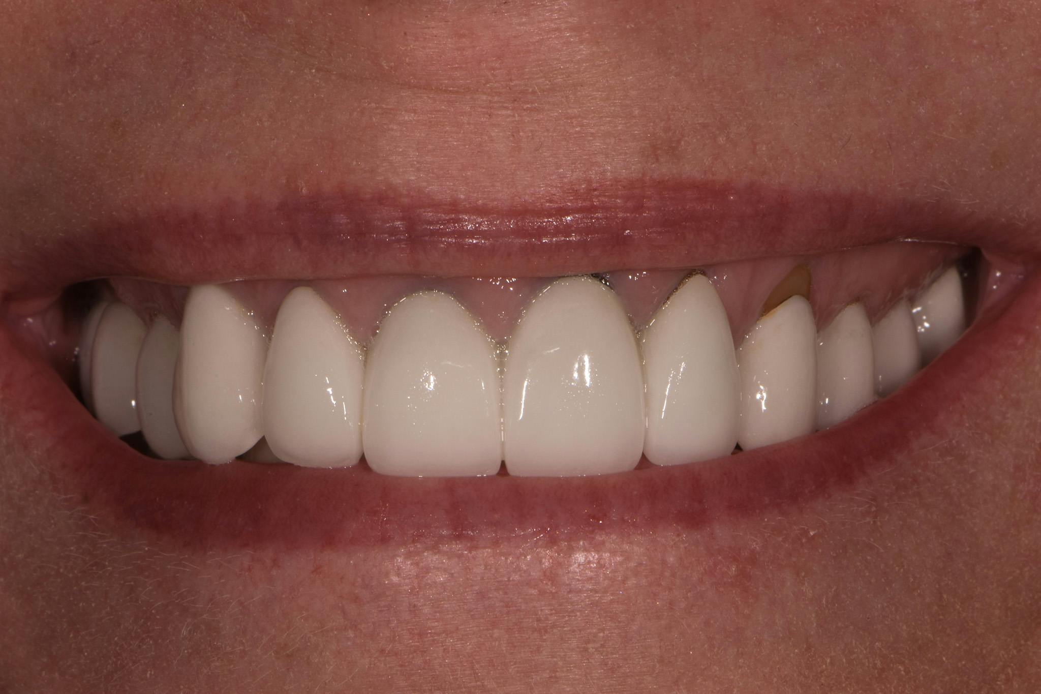 Before & After Photos | Charleston Center for Cosmetic and Restorative Dentistry - Bridges - Patient 1 - Before Procedure
