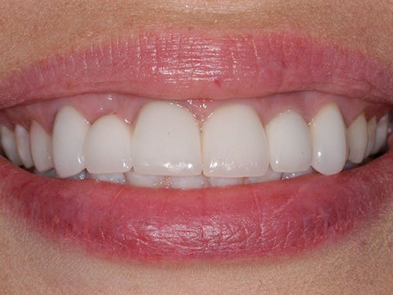 Bridges Before & After Gallery - Patient 363817 - Image 1