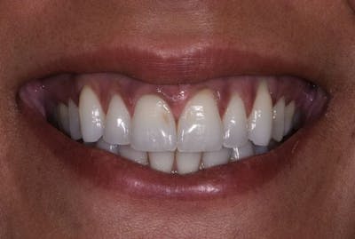 Composite Bonding Before & After Gallery - Patient 289440 - Image 1