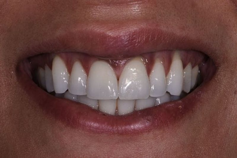 Composite Bonding Before & After Gallery - Patient 289440 - Image 2