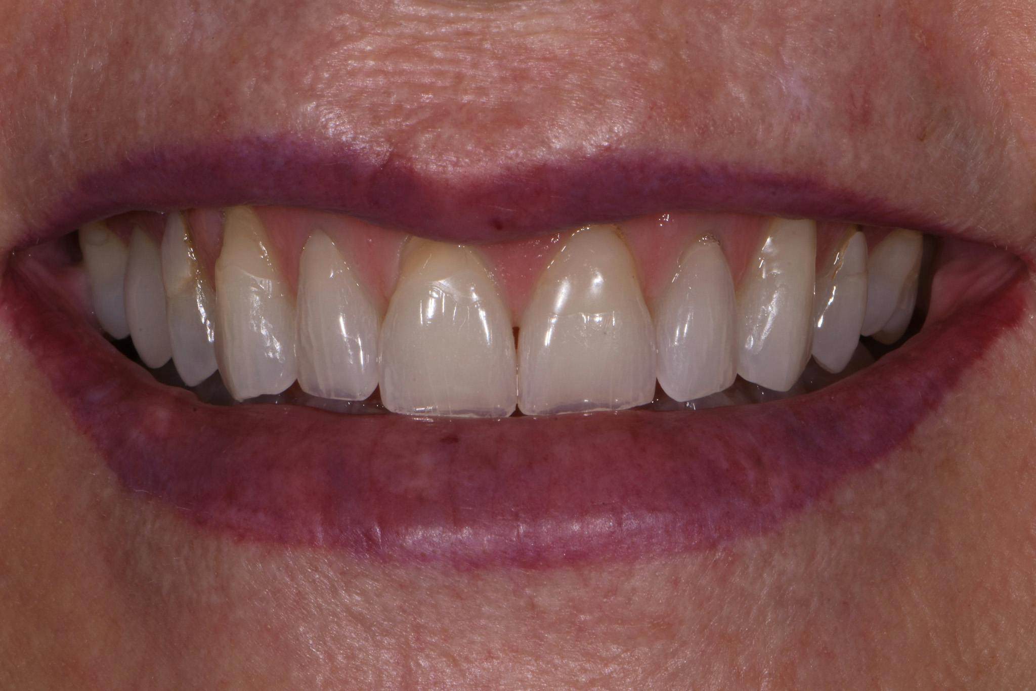 Porcelain Veneers Before & After Gallery - Patient 100417 - Image 1