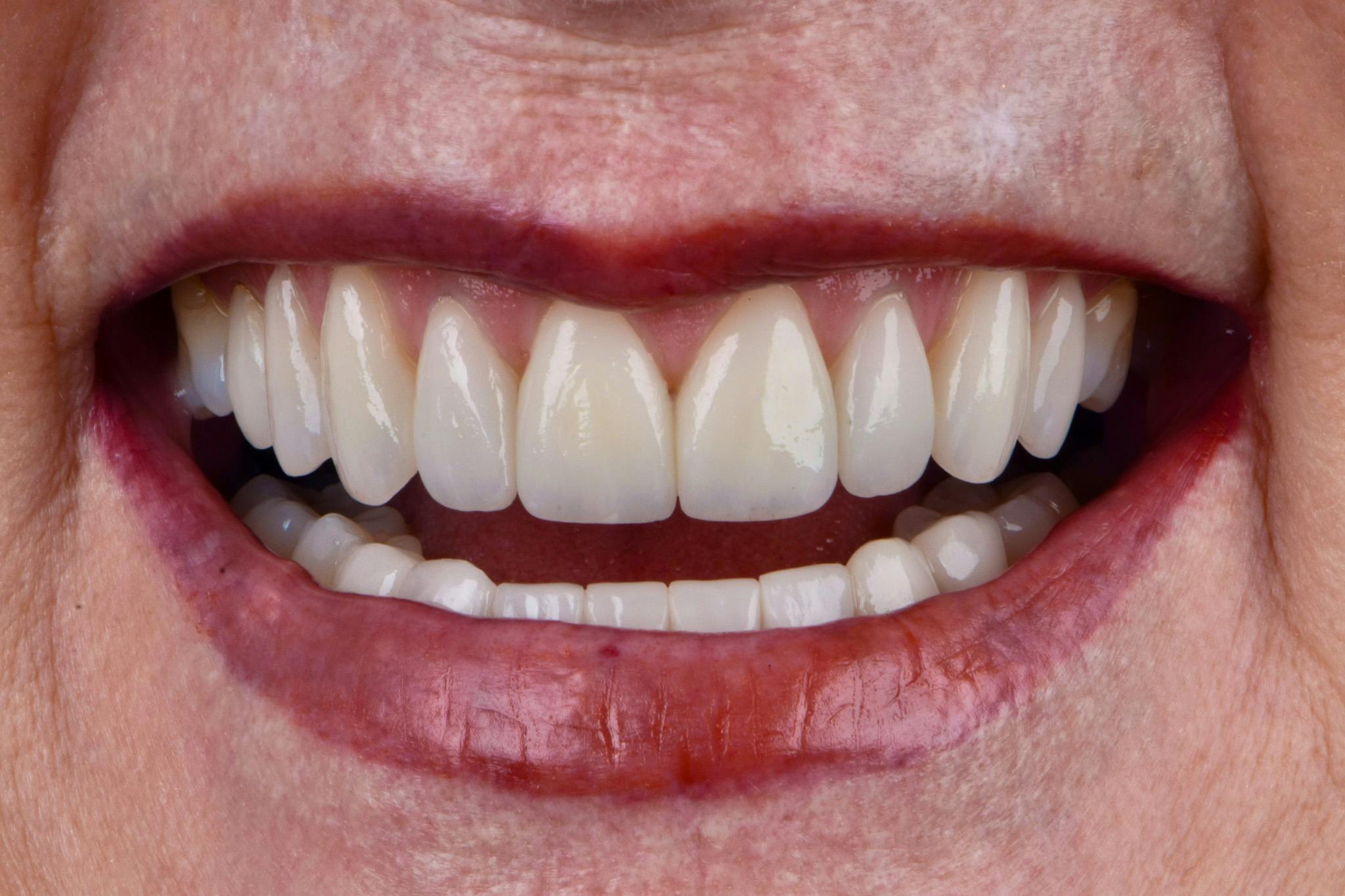 Porcelain Veneers Before & After Gallery - Patient 100417 - Image 2