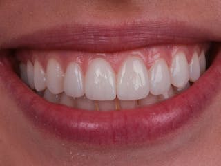 Porcelain Veneers Before & After Gallery - Patient 116769 - Image 2