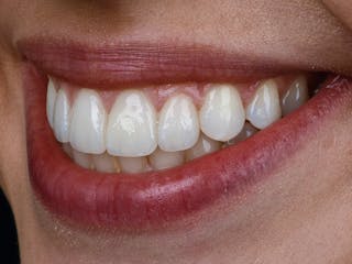 Porcelain Veneers Before & After Gallery - Patient 116769 - Image 4