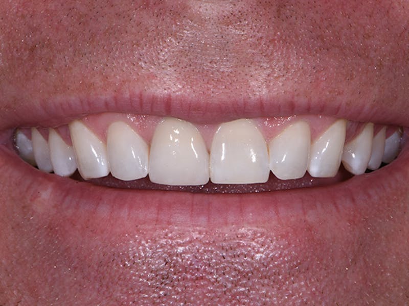 Porcelain Veneers Before & After Gallery - Patient 260962 - Image 2