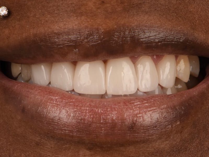 Porcelain Veneers Before & After Gallery - Patient 297166 - Image 2