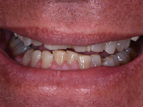 Porcelain Veneers Before & After Gallery - Patient 125769 - Image 1