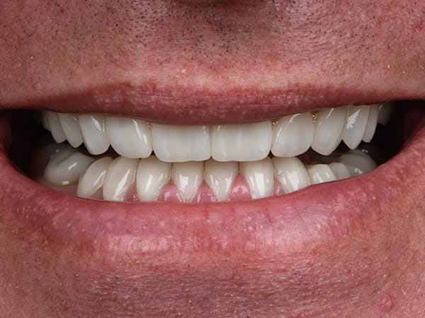 Porcelain Veneers Before & After Gallery - Patient 125769 - Image 2