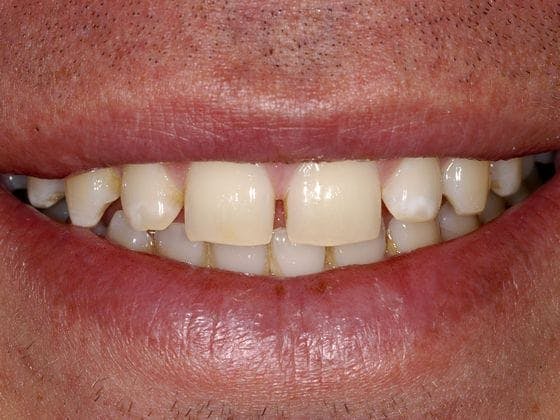 Porcelain Veneers Before & After Gallery - Patient 130793 - Image 1
