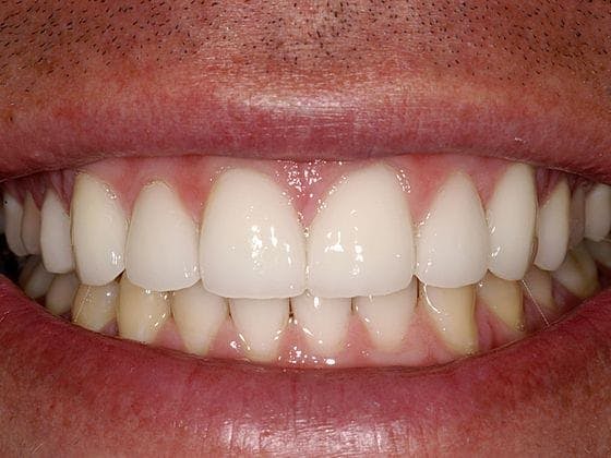 Porcelain Veneers Before & After Gallery - Patient 130793 - Image 2