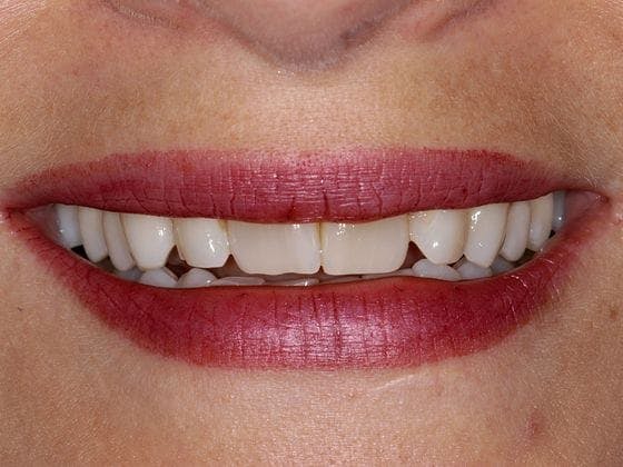 Porcelain Veneers Before & After Gallery - Patient 356711 - Image 1
