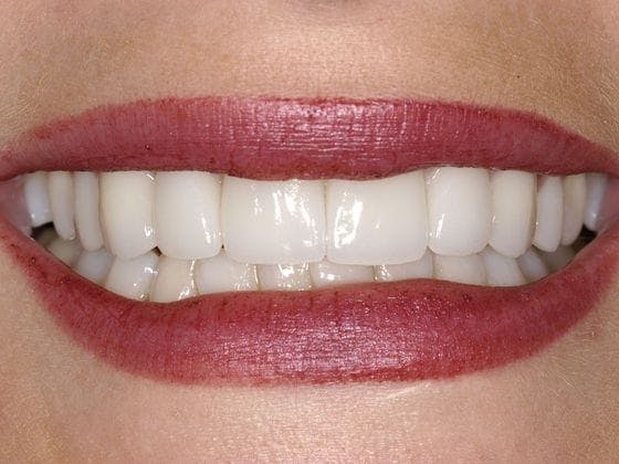Porcelain Veneers Before & After Gallery - Patient 356711 - Image 2