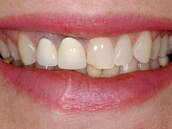 Porcelain Veneers Before & After Gallery - Patient 291863 - Image 1
