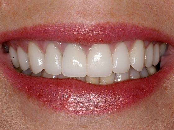 Porcelain Veneers Before & After Gallery - Patient 291863 - Image 2