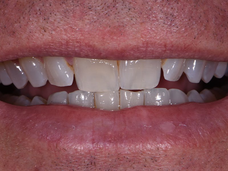 Porcelain Veneers Before & After Gallery - Patient 383248 - Image 1