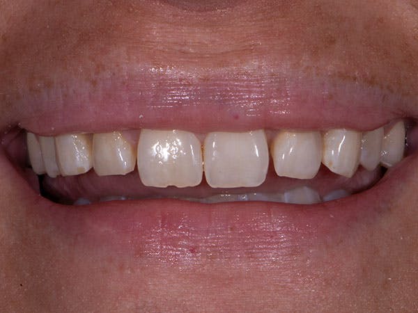 Porcelain Veneers Before & After Gallery - Patient 952304 - Image 1