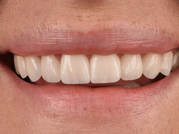 Porcelain Veneers Before & After Gallery - Patient 952304 - Image 2