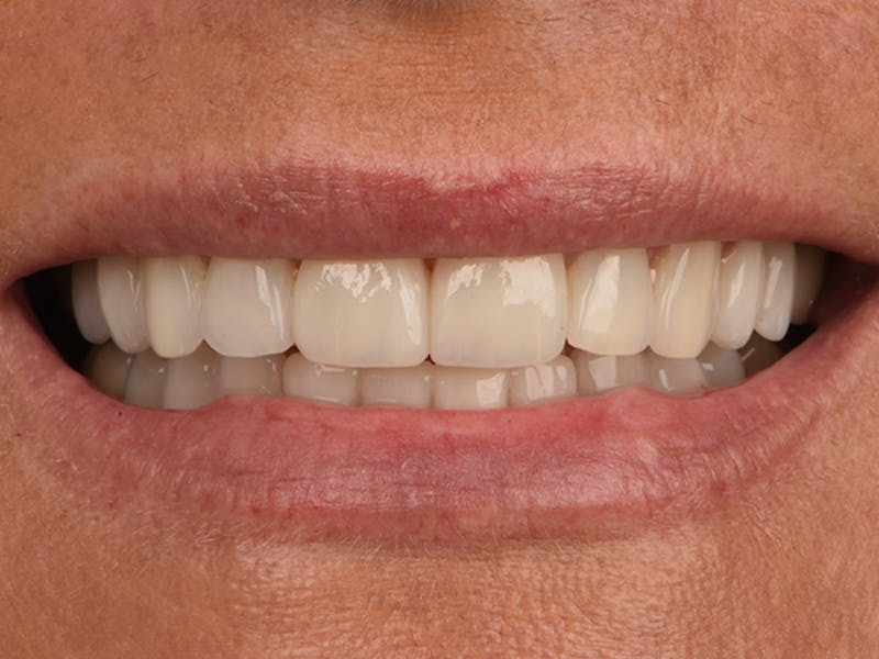 Porcelain Veneers Before & After Gallery - Patient 198279 - Image 2