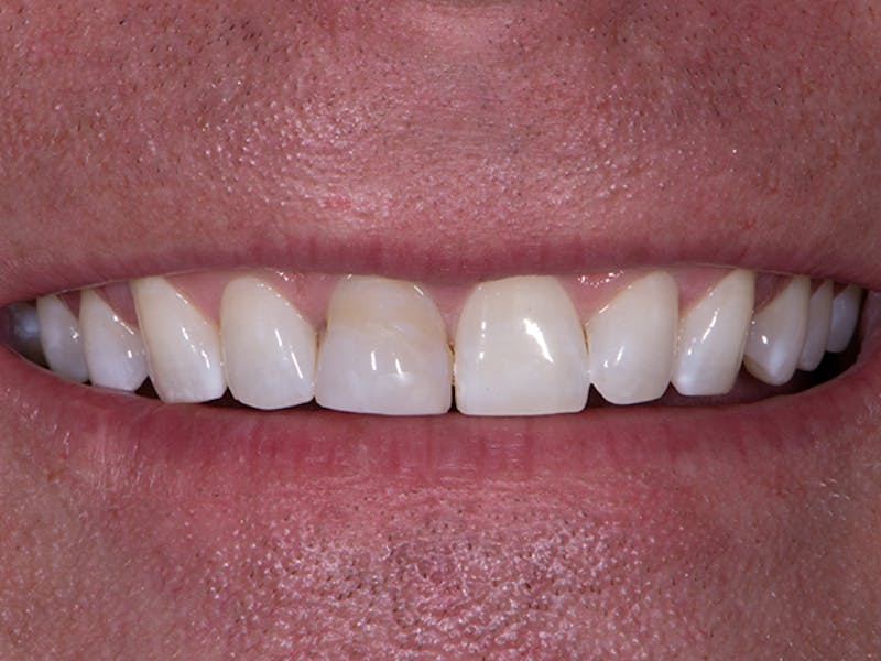 Porcelain Veneers Before & After Gallery - Patient 218566 - Image 1