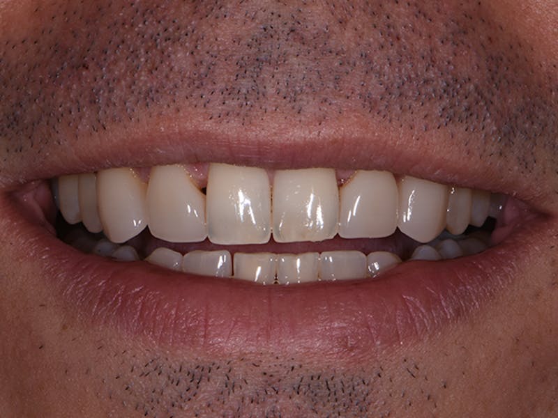 Porcelain Veneers Before & After Gallery - Patient 442571 - Image 1