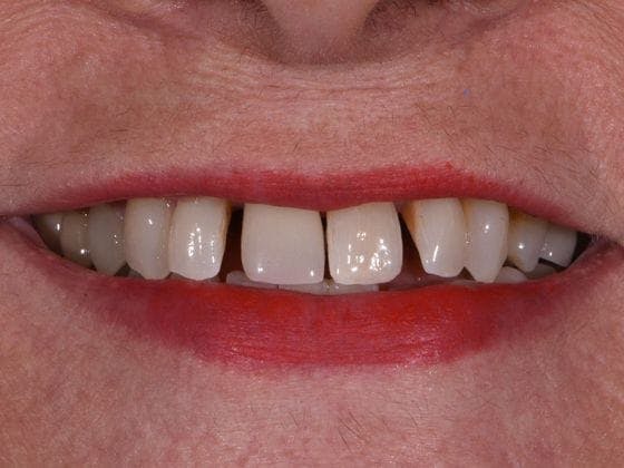 Dental Implants Before & After Gallery - Patient 412358 - Image 1