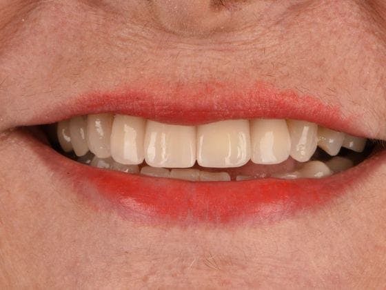 Dental Implants Before & After Gallery - Patient 412358 - Image 2