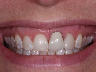Dental Implants Before & After Gallery - Patient 250964 - Image 1