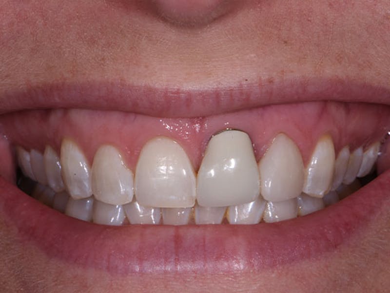 Dental Implants Before & After Gallery - Patient 250964 - Image 1