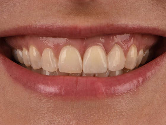 Before & After Photos | Charleston Center for Cosmetic and Restorative Dentistry - Dental Implants - Patient 3 - After Procedure