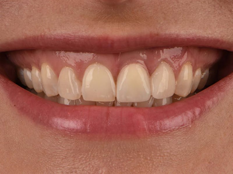 Dental Implants Before & After Gallery - Patient 250964 - Image 2