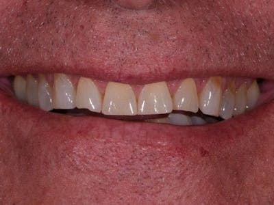 Prep-less Veneers Before & After Gallery - Patient 117386 - Image 1