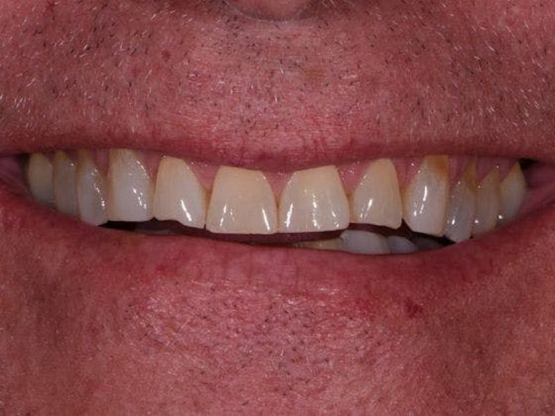 Prep-less Veneers Before & After Gallery - Patient 117386 - Image 1