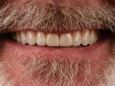 Prep-less Veneers Before & After Gallery - Patient 117386 - Image 2