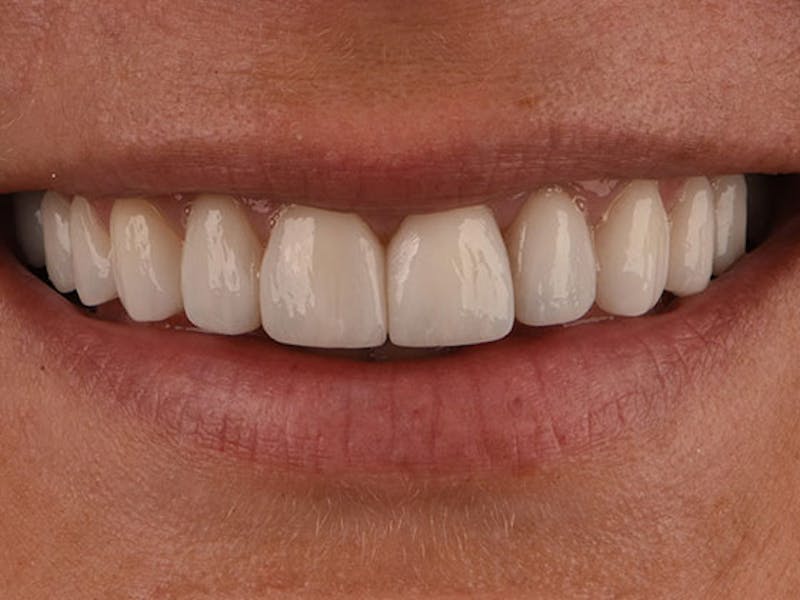 Prep-less Veneers Before & After Gallery - Patient 139977 - Image 2