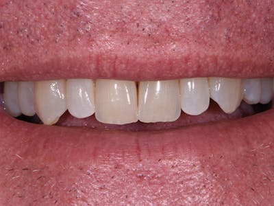 Prep-less Veneers Before & After Gallery - Patient 896281 - Image 1