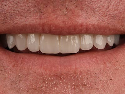 Prep-less Veneers Before & After Gallery - Patient 896281 - Image 2