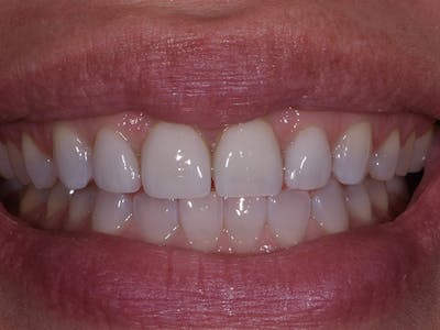 Prep-less Veneers Before & After Gallery - Patient 319754 - Image 1