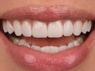 Prep-less Veneers Before & After Gallery - Patient 319754 - Image 2