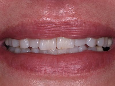 Prep-less Veneers Before & After Gallery - Patient 306287 - Image 1