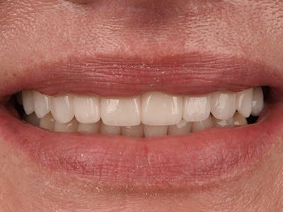 Prep-less Veneers Before & After Gallery - Patient 306287 - Image 2