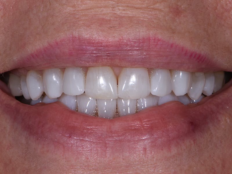 Teeth Whitening Before & After Gallery - Patient 195594 - Image 2