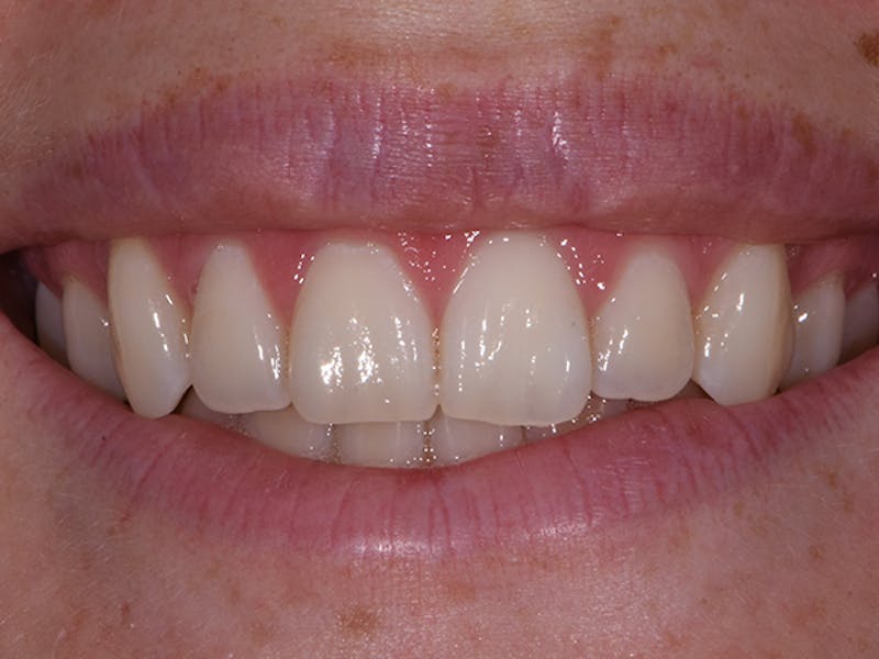 Teeth Whitening Before & After Gallery - Patient 116206 - Image 1