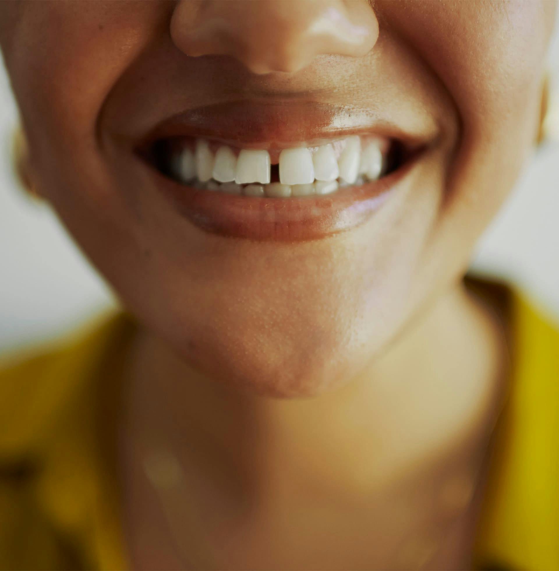 close up on woman's gapped front 2 teeth