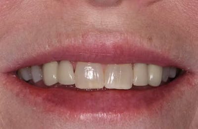 Full Mouth Restoration Before & After Gallery - Patient 303098 - Image 1