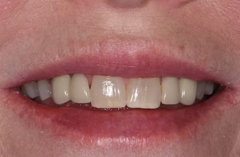 Full Mouth Restoration Before & After Gallery - Patient 303098 - Image 1