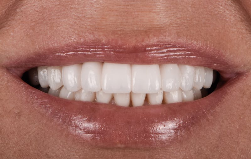 Full Mouth Restoration Before & After Gallery - Patient 410825 - Image 2